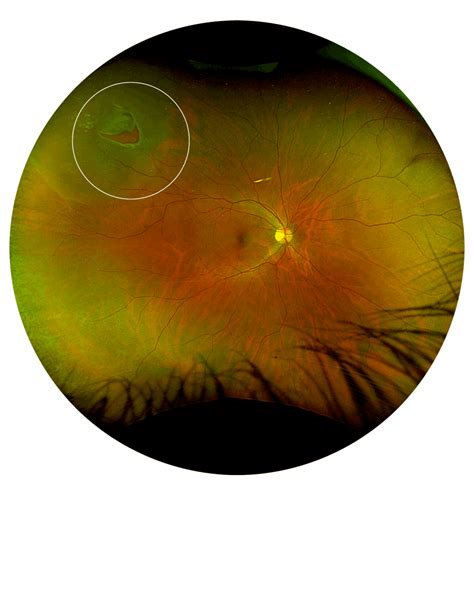 is a retinal tear serious